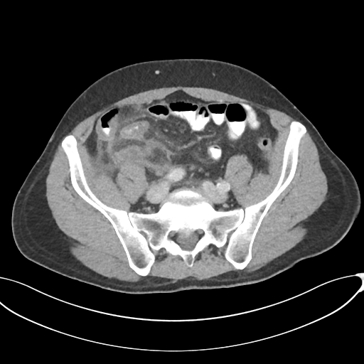Appendicitis with thickening of the terminal ileum (Radiopaedia 42432-45550 A 72).png