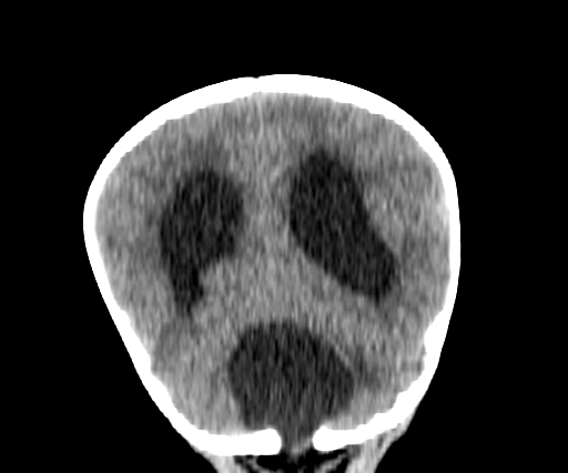 Arachnoid cyst-posterior fossa (Radiopaedia 88661-105370 Coronal non-contrast 56).jpg