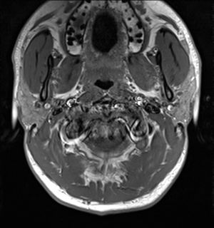 File:Arachnoid cyst - cerebellopontine angle (Radiopaedia 59689-67083 Axial T1 1).png