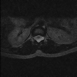 File:Arachnoid cyst - spinal (Radiopaedia 66835-76157 Axial T2 3).jpg
