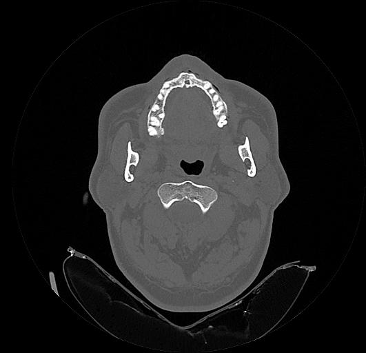 Arcuate foramen (Radiopaedia 89833-106944 Axial bone window 50).jpg