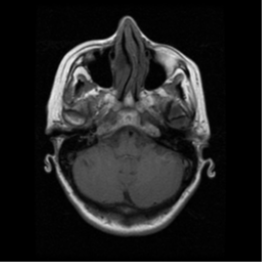 File:Arteriovenous malformation (cerebral) (Radiopaedia 40070-42580 Axial T1 4).png