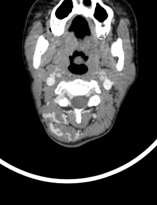 Arteriovenous malformation of the neck (Radiopaedia 53935-60062 B 12).jpg