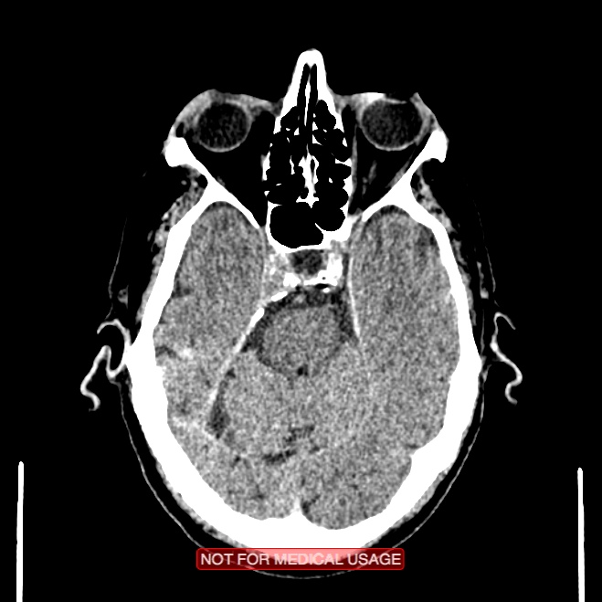 Artery of Percheron infarction (Radiopaedia 28679-28967 Axial non-contrast 39).jpg