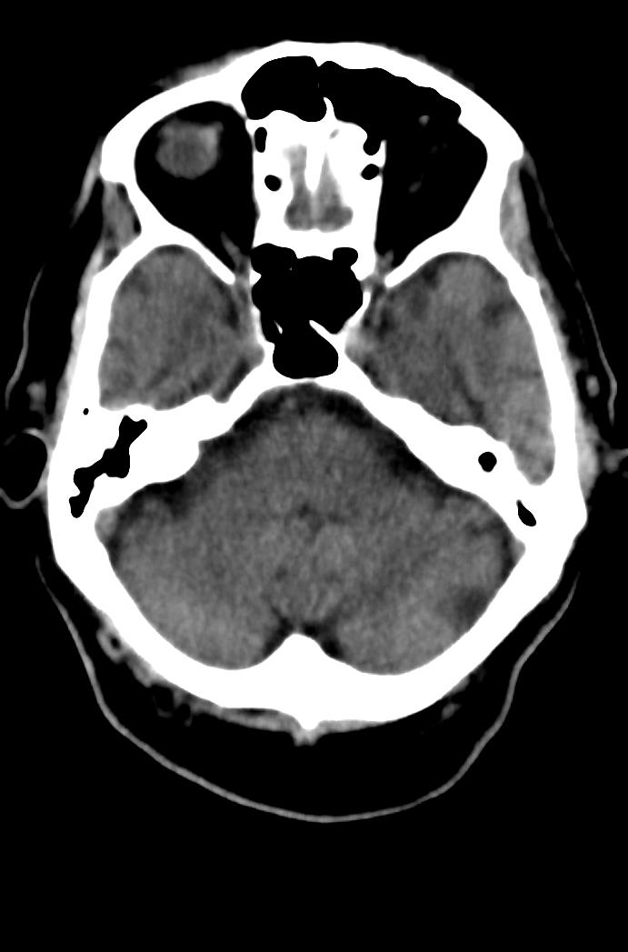 Artery of Percheron infarction (Radiopaedia 80613-94202 Axial non-contrast 56).jpg