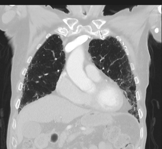 Asbestosis (Radiopaedia 56192-62864 Coronal lung window 17).png