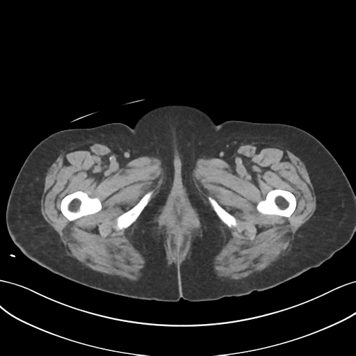 File:Ascending cholangitis (Radiopaedia 39068-41253 Axial non-contrast 76).png
