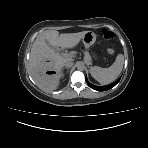 Ascending retrocecal appendicitis with liver abscesses (Radiopaedia 60066-67615 Axial non-contrast 23).jpg