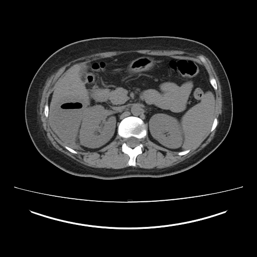 Ascending retrocecal appendicitis with liver abscesses (Radiopaedia 60066-67615 Axial non-contrast 31).jpg