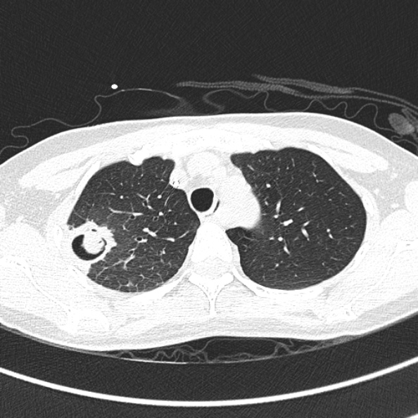 File:Aspergilloma (Radiopaedia 26223-26347 Axial lung window 20).jpg