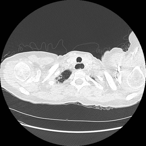 Aspiration pneumonia secondary to laparoscopic banding (Radiopaedia 18345-18183 lung window 1).jpg