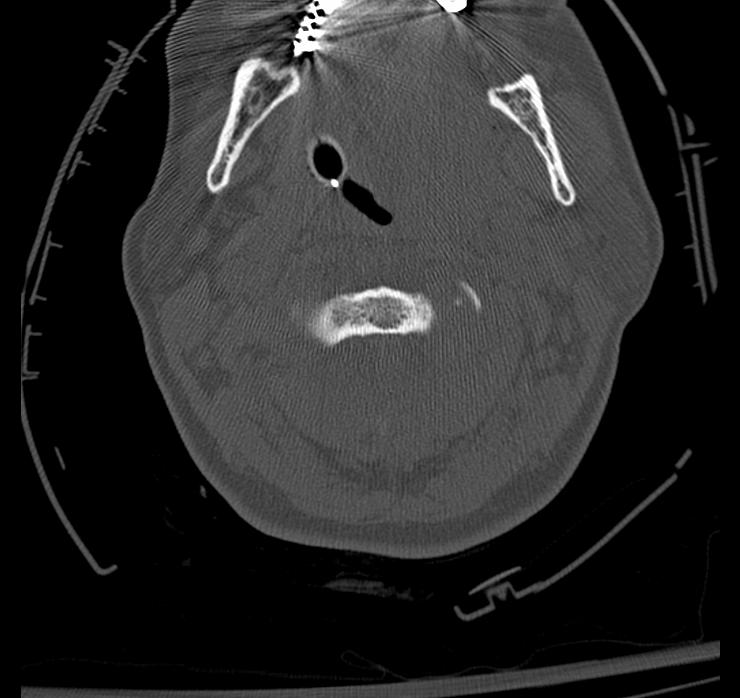 Atlanto-axial subluxation-dislocation (Radiopaedia 29659-30185 Axial bone window 36).jpg