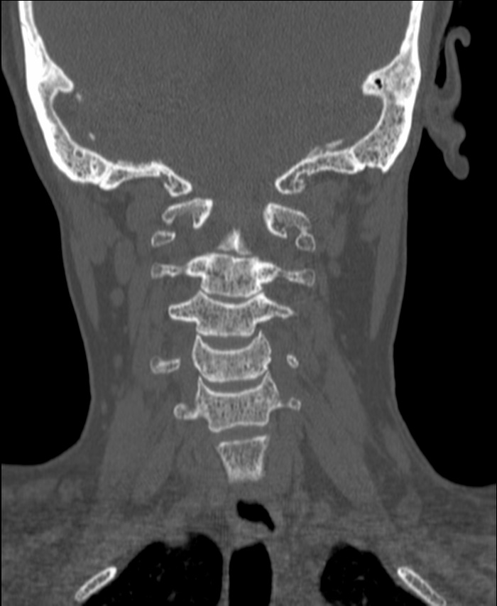 Atlanto-occipital assimilation with basilar invagination (Radiopaedia 70122-80188 Coronal bone window 109).jpg