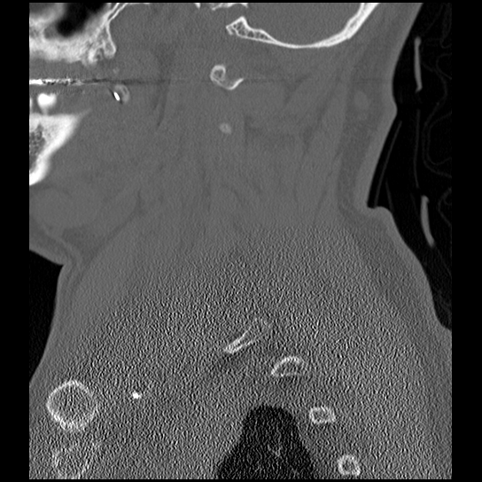 Atlanto-occipital dissociation injury (Radiopaedia 29274-29698 Sagittal bone window 13).png