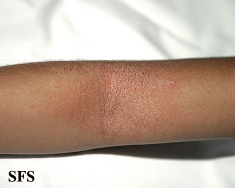 Atopic Dermatitis (Dermatology Atlas 26).jpg