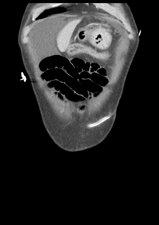 Atraumatic splenic rupture (Radiopaedia 42931-46160 B 8).png