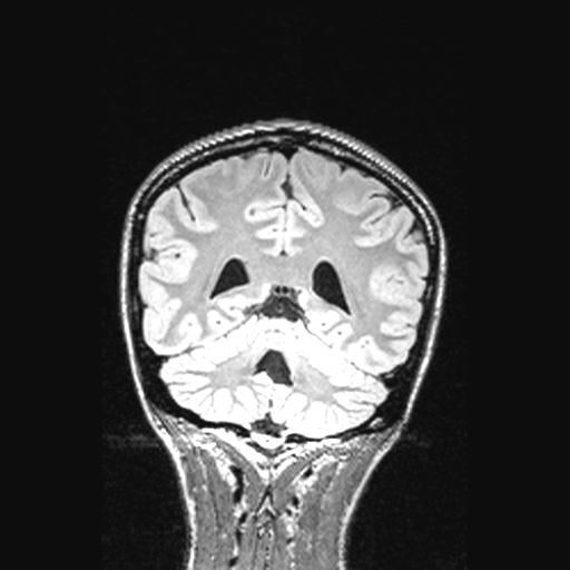 File:Atretic encephalocoele with inferior vermis hypoplasia (Radiopaedia 30443-31108 Coronal FLAIR 63).jpg