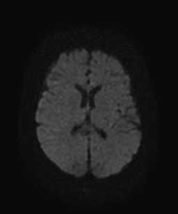File:Atretic parietal cephalocele (Radiopaedia 64350-73135 Axial DWI 14).jpg