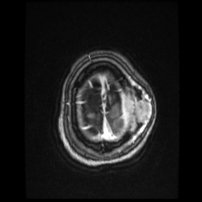 Atypical meningioma (Radiopaedia 45535-49629 Axial T1 C+ 60).jpg