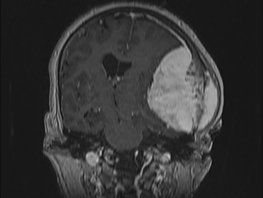 File:Atypical meningioma (Radiopaedia 62985-71406 Coronal T1 C+ 62).jpg