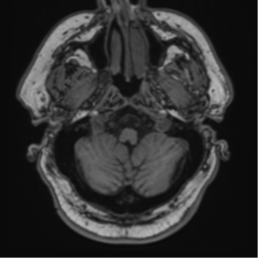 File:Atypical meningioma (WHO grade II) with brain invasion (Radiopaedia 57767-64729 Axial T1 6).png