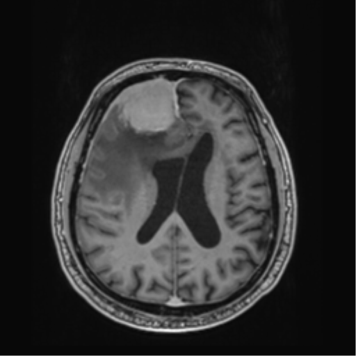 Atypical meningioma (WHO grade II) with brain invasion (Radiopaedia 57767-64729 Axial T1 C+ 30).png