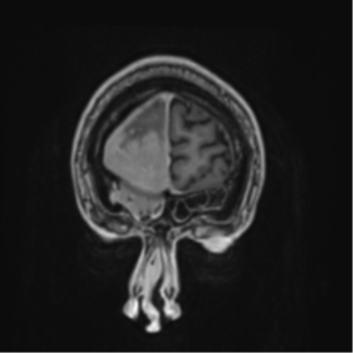 Atypical meningioma (WHO grade II) with brain invasion (Radiopaedia 57767-64729 Coronal T1 C+ 3).png