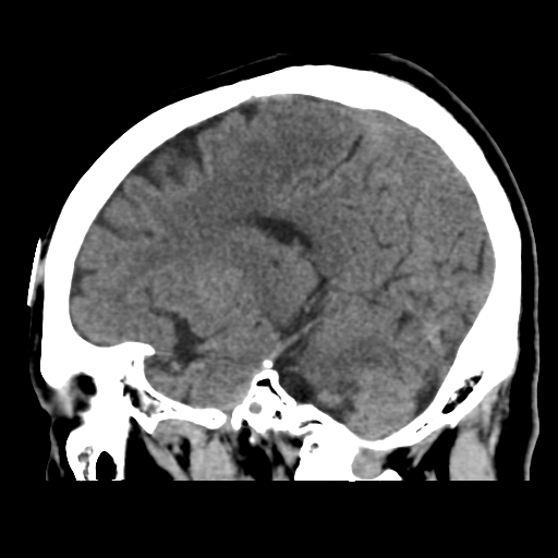 Atypical meningioma (WHO grade II) with osseous invasion (Radiopaedia 53654-59715 C 34).png