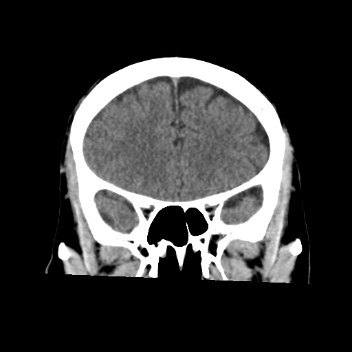 Atypical meningioma with skull invasion (Radiopaedia 34357-35649 Coronal non-contrast 22).png