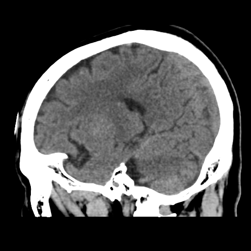 Atypical meningioma with skull invasion (Radiopaedia 34357-35649 E 35).png