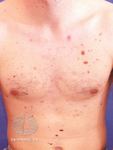 File:Atypical naevi (DermNet NZ lesions-atypical-naevi-611).jpg