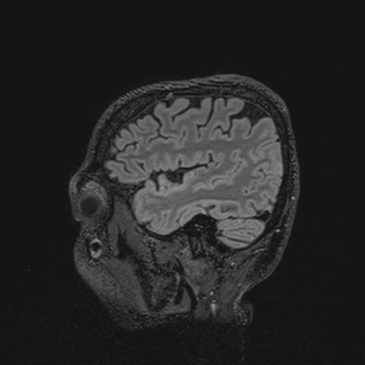 Autoimmune limbic encephalitis (Radiopaedia 30363-31005 Sagittal FLAIR 38).jpg