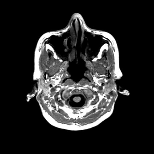 Autoimmune limbic encephalitis (Radiopaedia 30363-31005 T1 Axial 1mm 15).jpg
