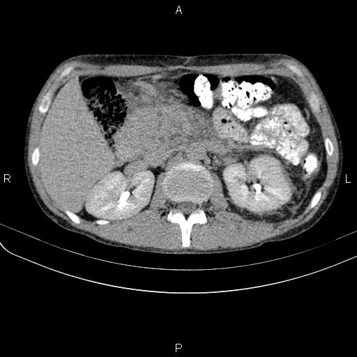 Autoimmune pancreatitis (Radiopaedia 84925-100431 Axial C+ delayed 27).jpg