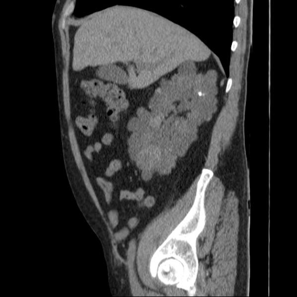 File:Autosomal dominant polycystic kidney disease (Radiopaedia 36539-38101 D 26).jpg