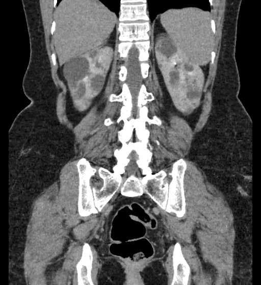 File:Autosomal dominant polycystic kidney disease (Radiopaedia 38189-40194 Coronal C+ delayed 80).jpg