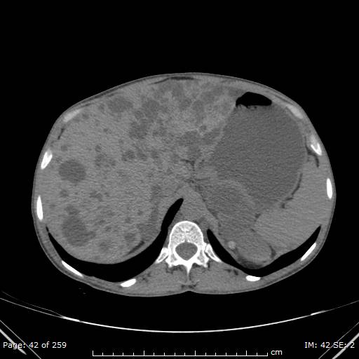 File:Autosomal dominant polycystic kidney disease (Radiopaedia 44122-47684 Axial 65).jpg