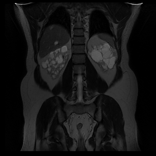 File:Autosomal dominant polycystic kidney disease (Radiopaedia 50259-55611 Coronal T2 27).jpg