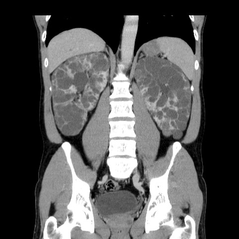 Autosomal dominant polycystic kidney disease (Radiopaedia 66349-75582 A 56).jpg