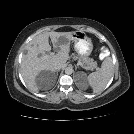 File:Autosomal dominant polycystic kidney disease with hepatic involvement (Radiopaedia 32693-33662 C 17).jpg