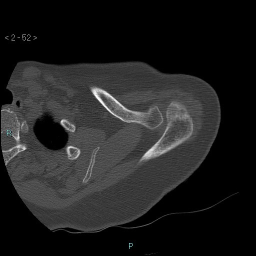 Avascular necrosis of the shoulder - Cruess stage I (Radiopaedia 77674-89887 Axial bone window 13).jpg