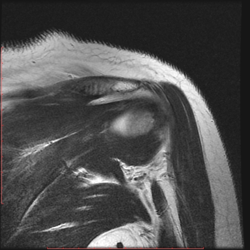 File:Avulsion fracture - greater tuberosity of humerus (Radiopaedia 25457-25703 Coronal T2 11).jpg