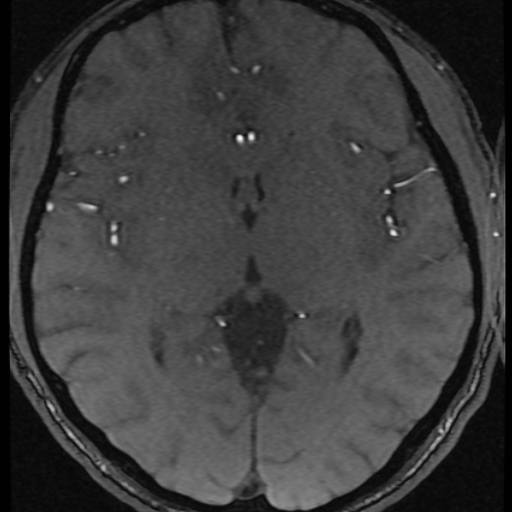 Azygos anterior cerebral artery (Radiopaedia 17059-16756 Axial MRA 18).jpg