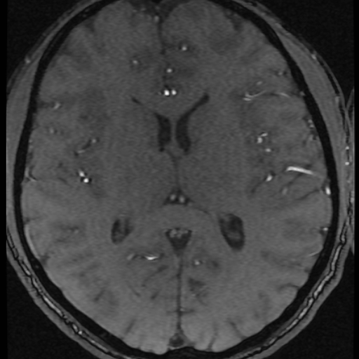 Azygos anterior cerebral artery (Radiopaedia 17059-16756 Axial MRA 4).jpg
