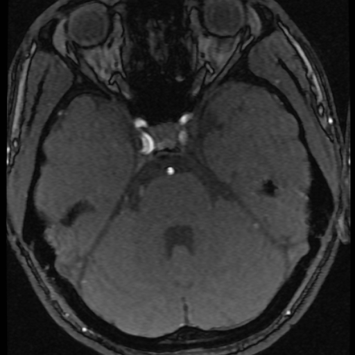 Azygos anterior cerebral artery (Radiopaedia 17059-16756 Axial MRA 57).jpg