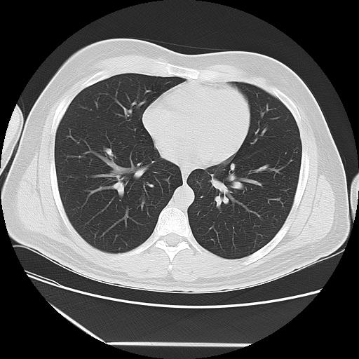 Azygos fissure (Radiopaedia 88181-104784 Axial lung window 32).jpg