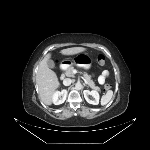 B-cell lymphoma of the mesentery (Radiopaedia 65711-74827 A 40).jpg