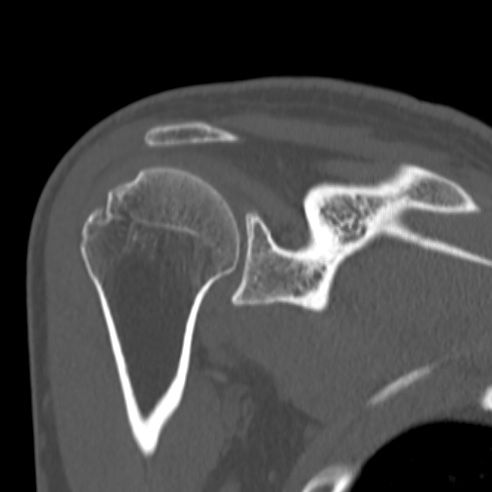 Bankart lesion (Radiopaedia 57256-64185 Coronal bone window 29).jpg
