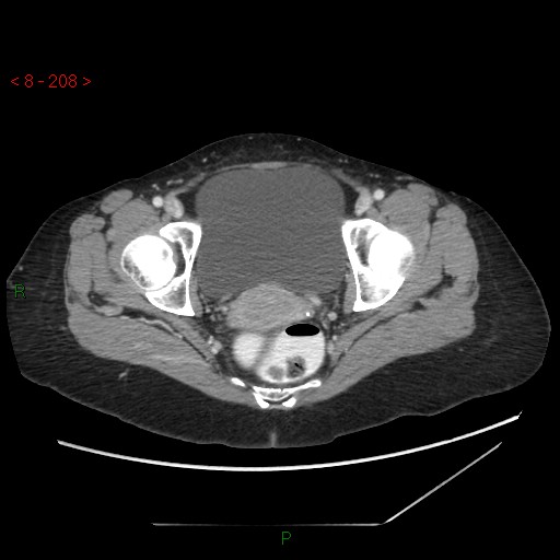 Bartholin gland cyst (Radiopaedia 54904-61181 A 52).jpg