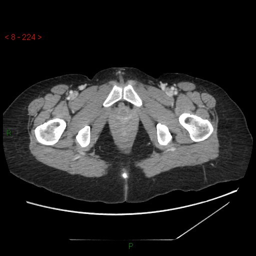 Bartholin gland cyst (Radiopaedia 54904-61181 A 56).jpg